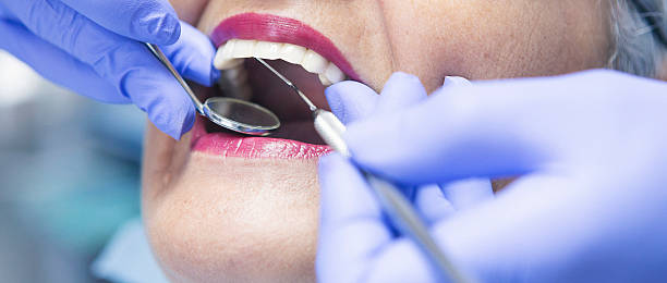 Best Knocked-Out Tooth (Avulsed Tooth) Treatment in La Riviera, CA
